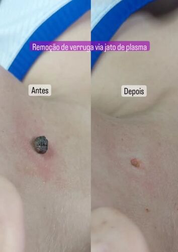 Antes e depois